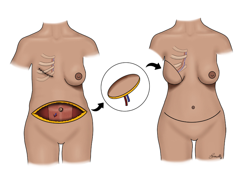 Breast Reconstruction - For Patients